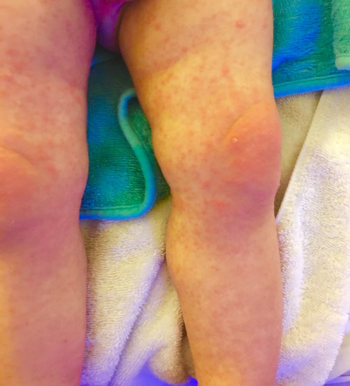 A picture of Matthew’s rash taken by Cassandra Csizmadia.