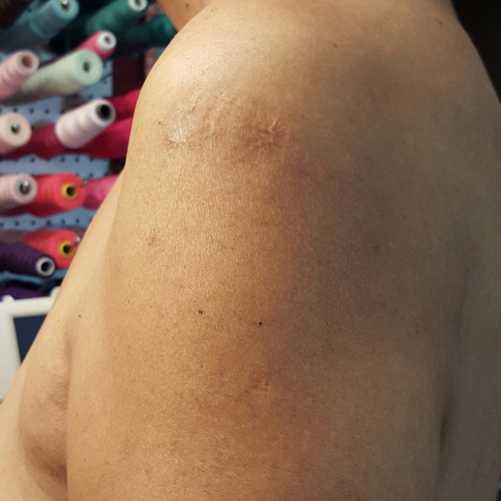 Jim White's shoulder, showing his scars