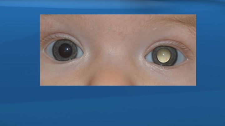 A photograph of baby Mason Low revealed the 3 month old had eye cancer