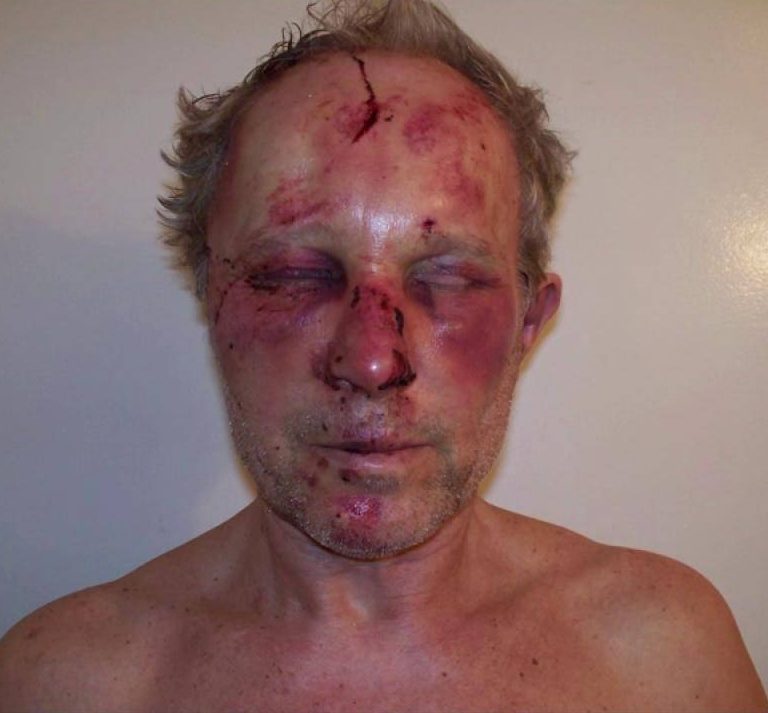 Vladimir Tchaikouns injuries seen in a photo following an encounter with Vancouver police at his home on March 13, 2016.