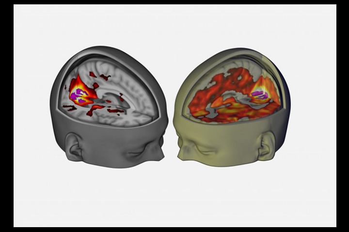 Using an MRI, scientists probed what goes on in the brain of someone on LSD.