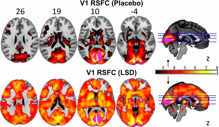 This image shows how, with eyes-closed, much more ofthe brain contributes to the visual experience underLSD than under placebo. The magnitude of this effectcorrelated with participants reports of complex,dreamlike visions.