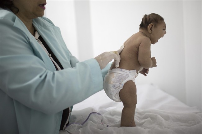 In this Friday, Feb. 12, 2016 file photo, Lara, who is less than 3-months old and was born with microcephaly, is examined by a neurologist at the Pedro I hospital in Campina Grande, Paraiba state, Brazil.