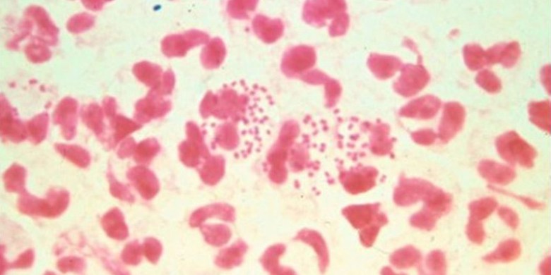 Untreatable gonorrhea may be on the horizon in Canada. Here's why