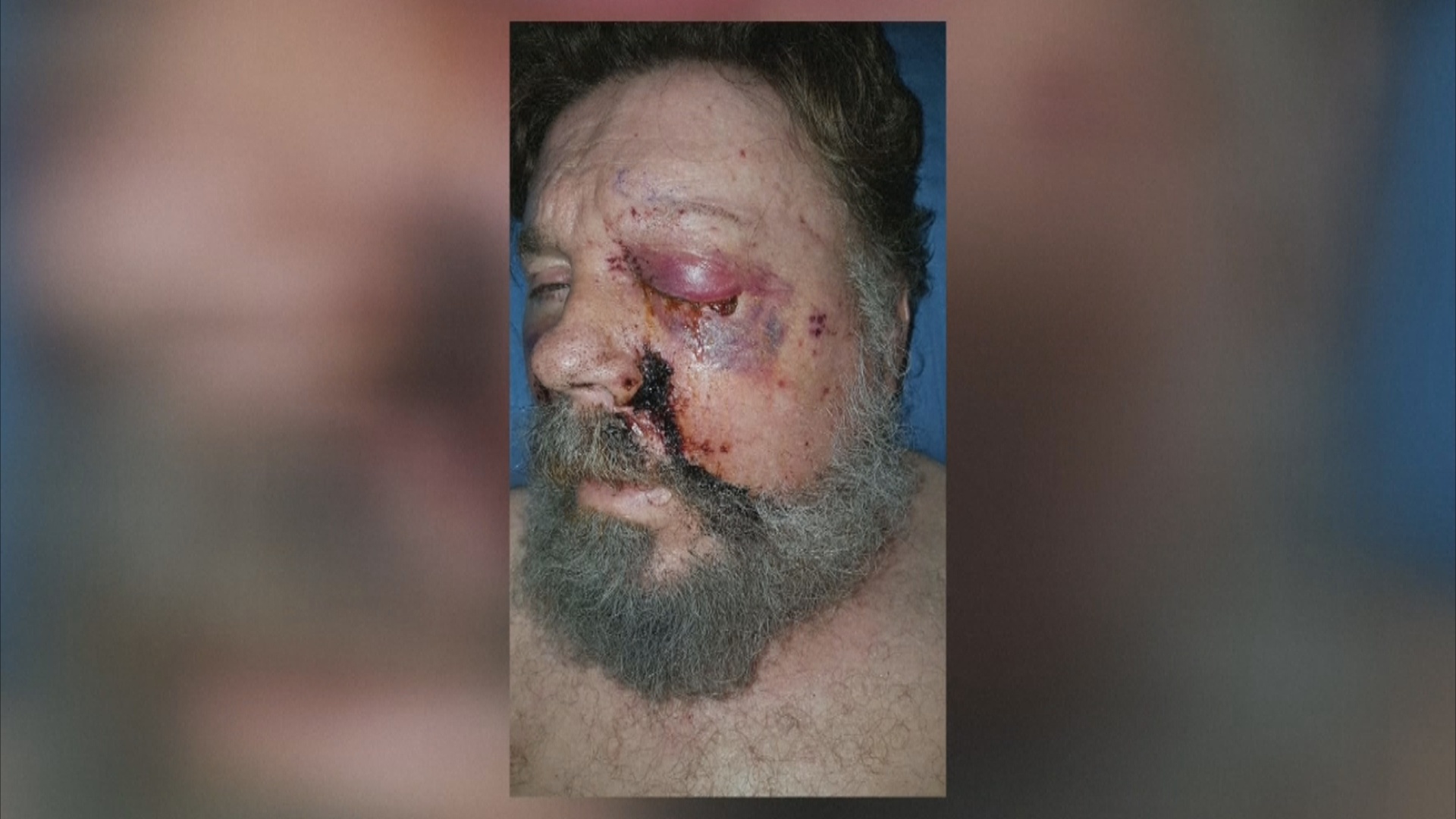 California man loses eye in e cigarette explosion National