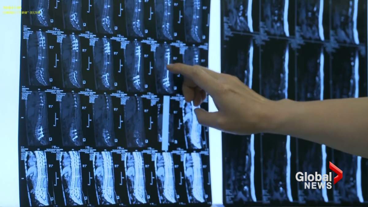 1st successful 3D printed spinal implant operation conducted in China - image