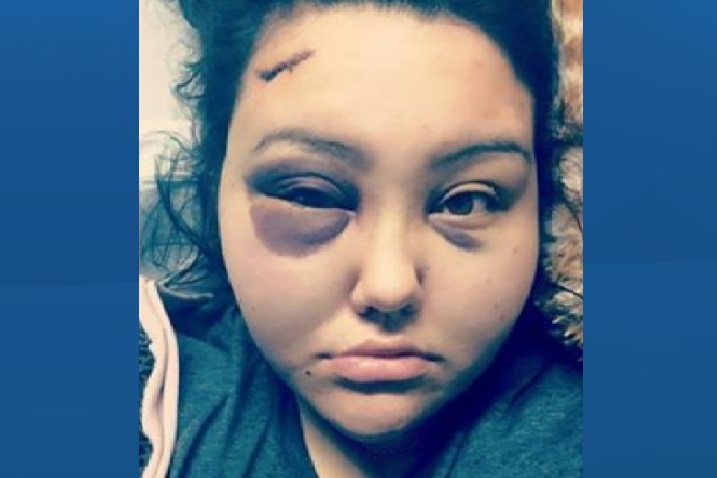 Jackie Healey, 23, has lost vision in her left eye after being beated with a billiard ball at the Selkirk Behavioural Health Foundation Sunday night. Two teenagers have been charged  in connection to the assault.
