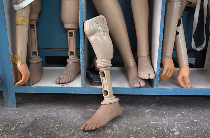 Black amputees face challenges and increased costs for prostheses
