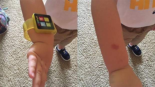 McDonald’s is recalling millions of fitness trackers that were distributed along with Happy Meals in Canada and the U.S. after reports of them burning children.