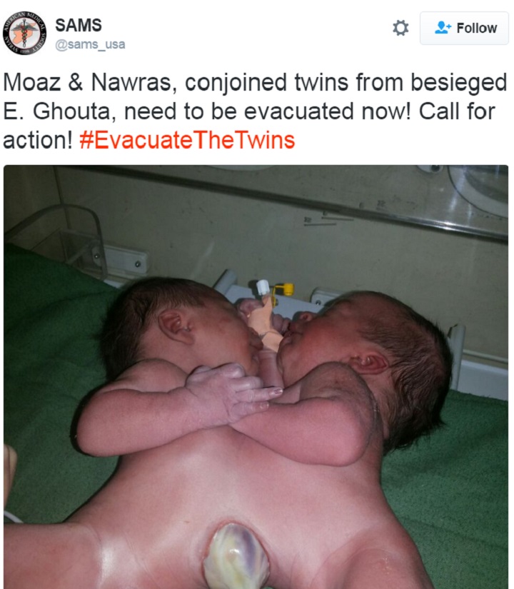 Conjoined Syrian twins, Moaz and Nawrus, are in desperate need of medical attention.