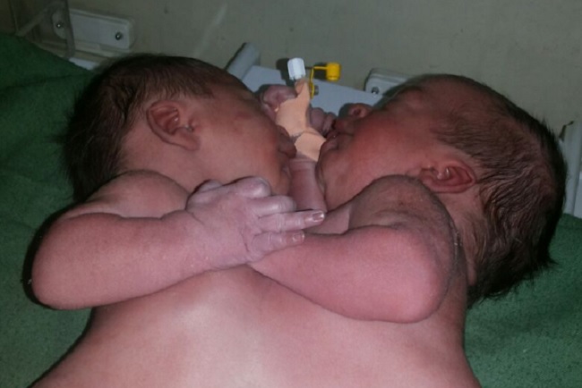 Conjoined twins, Moaz and Nawrus, were born July 23 in Syria.