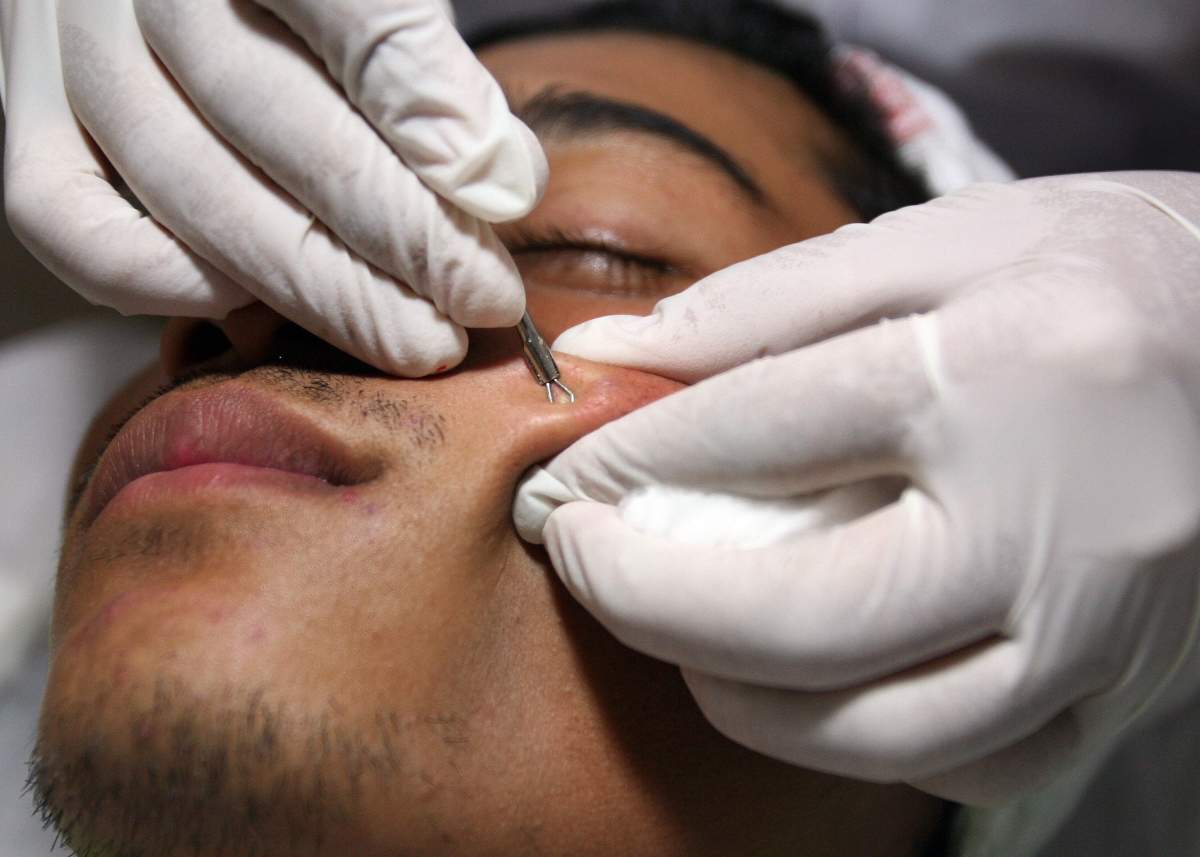 Scientists say acne sufferers have a different genetic make up in their skin that allows them to look younger longer.