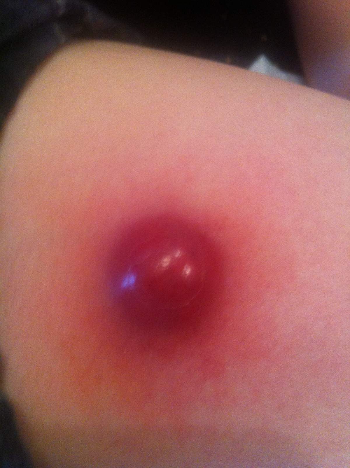 Gabriel discovered a growth on his leg shortly after his lung was removed. It was cancerous.