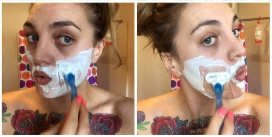 PCOS causes excessive facial hair in some women.