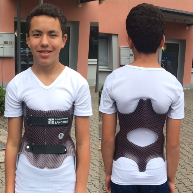 Scoliosis Back Brace Treatments for Active Kids and Teens