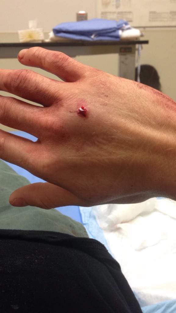 It wasn’t a firecracker. The wound was serious enough that Thomas had to be taken to hospital. Whatever it was that hit him went in through the top of his right hand and out through his palm.
