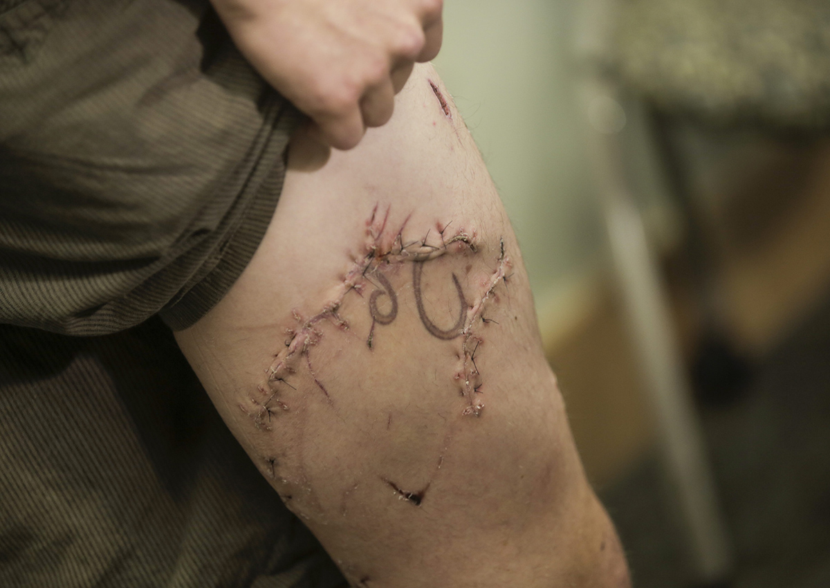 Joseph Tanner, who survived a shark bite while surfing on the Oregon Coast on Oct. 10, 2016, shows his scars while speaking with the media at Legacy Emanuel Medical Center in Portland, Ore., where he is a critical care nurse, Wednesday, Oct. 26, 2016.