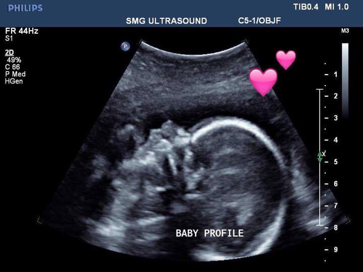 The Zimmer baby at 21 weeks in utero.
