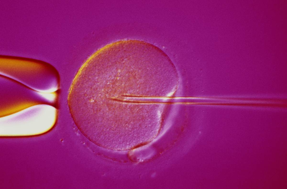 Intracytoplasmic Sperm Injection (ICSI) is an artificial fertilization technique. A single sperm is injected into the cytoplasm of an egg, via a microneedle. This technique is used in treatment of severe male infertility.
