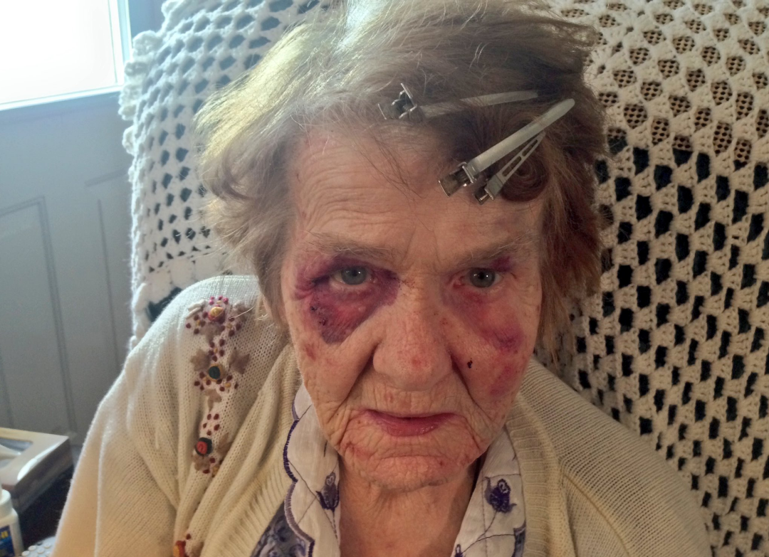 Jeanette MacDonald is badly bruised after being attacked in a scary home invasion Tuesday night in Halifax. 