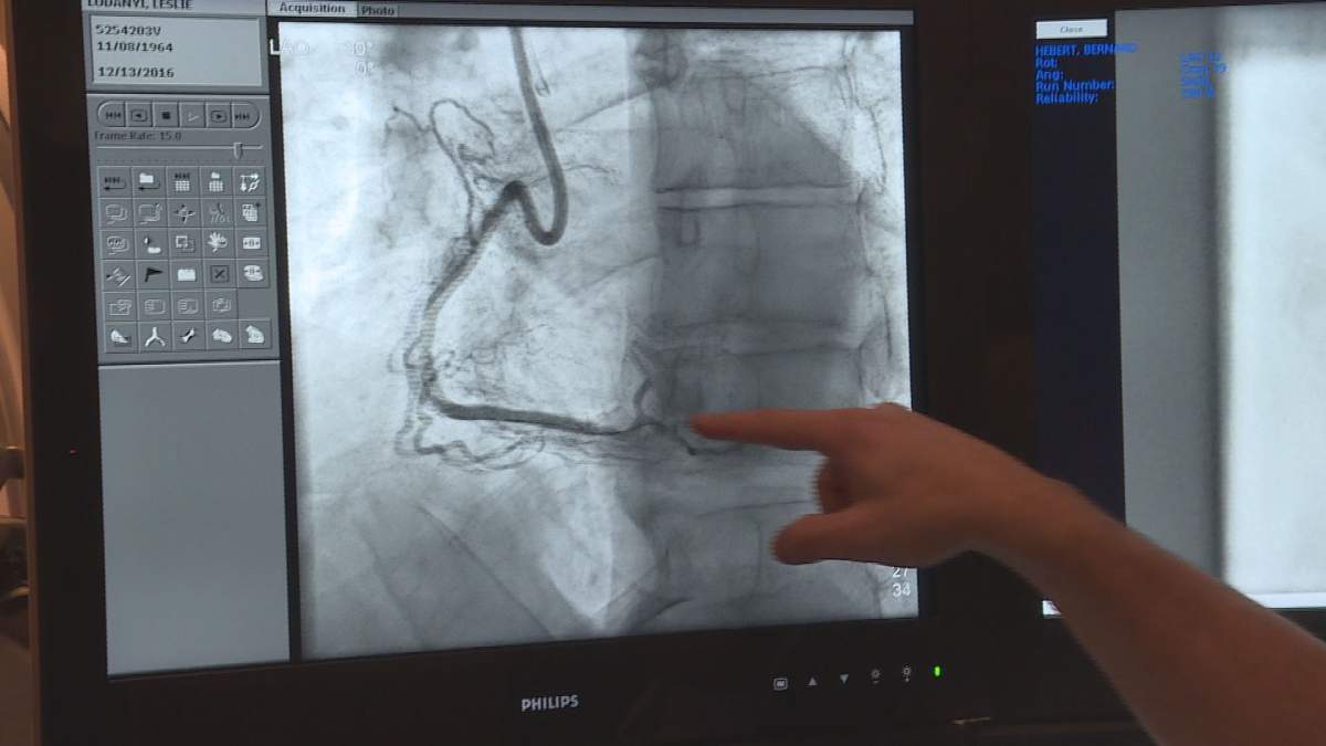 The MUHC became the first hospital to operate on a patient with clogged arteries with a new technology called TrapLiner. Dec. 13, 2016.