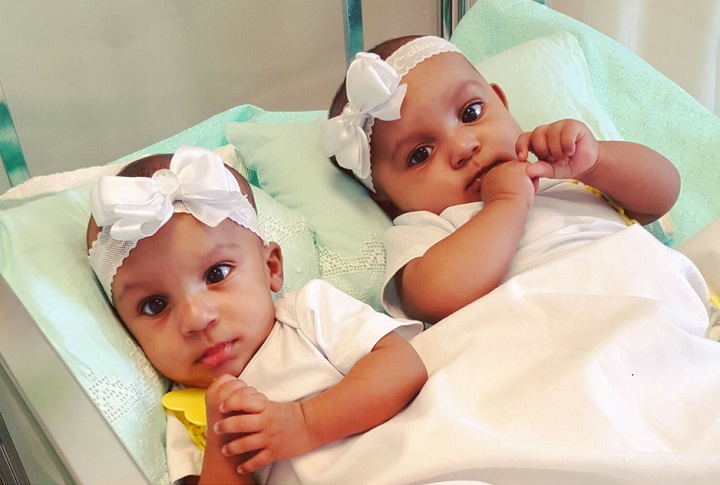 A team of more than 50 medical professionals helped perform the delicate 21-hour operation to separate Ballenie and Bellanie Camacho at Maria Fareri Children's Hospital in Valhalla over two days. (Handout, Maria Fareri Children's Hospital).