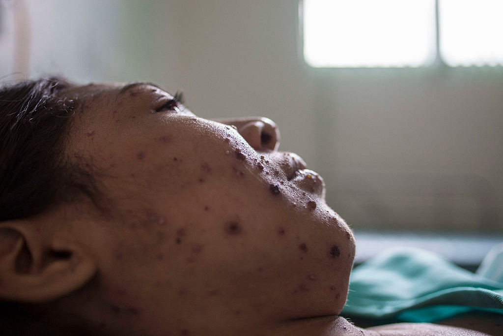 "It’s important to remember that measles is a killer," says University of Toronto epidemiologist David Fisman. "Measles causes brain disease, it causes pneumonia, particularly in undernourished children — we’re playing with fire here. ".