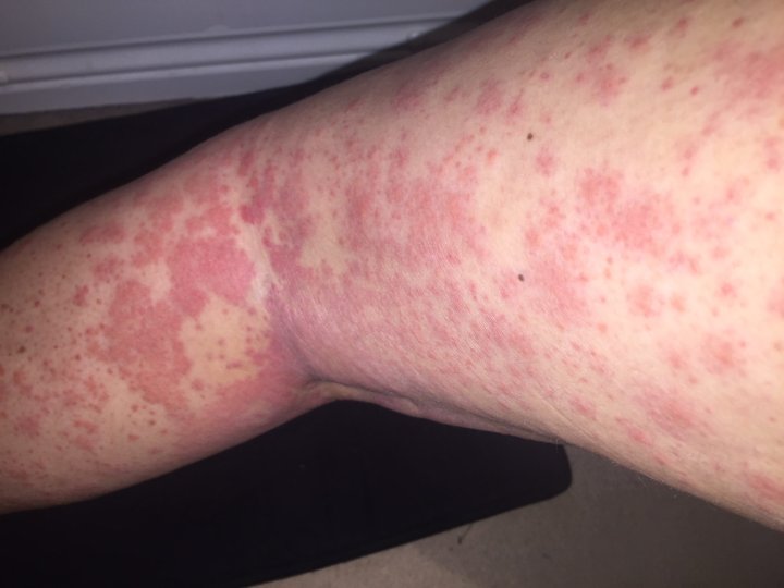 bizarre-rash-leads-to-cancer-diagnosis-for-young-woman-globalnews-ca