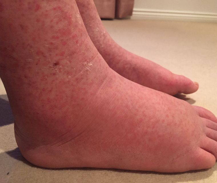 ‘Bizarre’ rash leads to cancer diagnosis for young woman - image