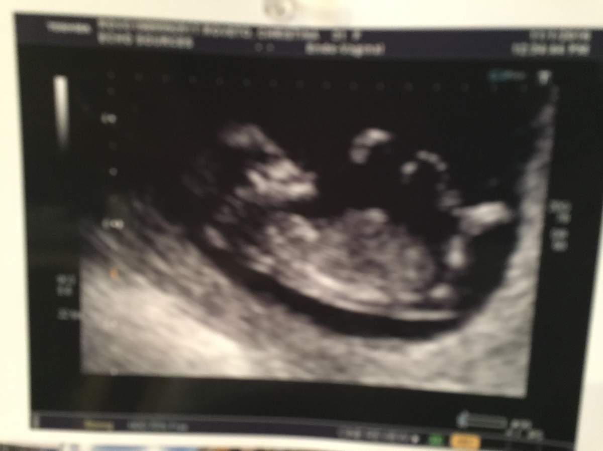 Christina Roveto’s ultrasound, Thursday, Jan. 19, 2017.
