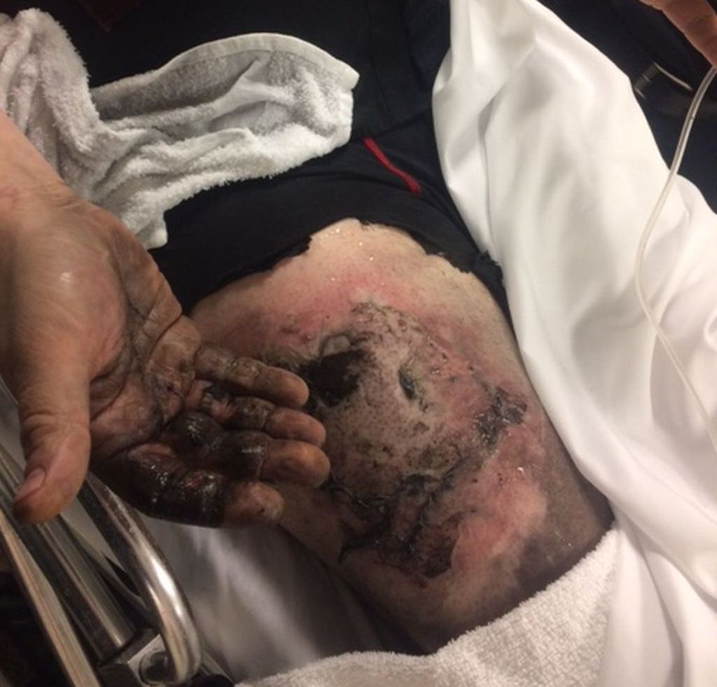 Calgary man suffers 3rd degree burns after e cigarette battery