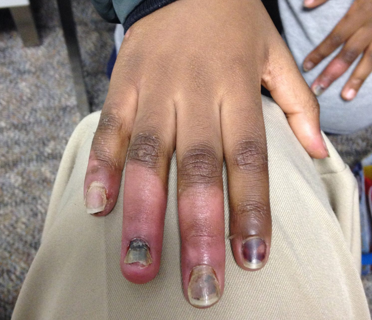 This image shows an extreme case of frostbite a patient suffered. (Canadian Centre for Refugee and Immigrant Healthcare/Facebook)