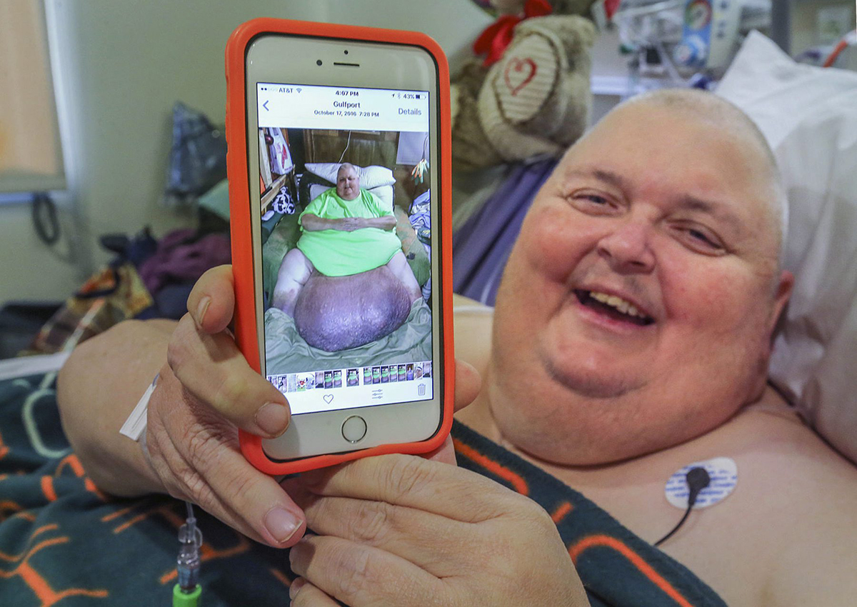 In this Feb. 2, 2017, photo, Roger Logan holds up a smartphone that shows a photo of him with a 130-pound tumor before a surgery to remove it at Bakersfield Memorial Hospital in Bakersfield, Calif. 