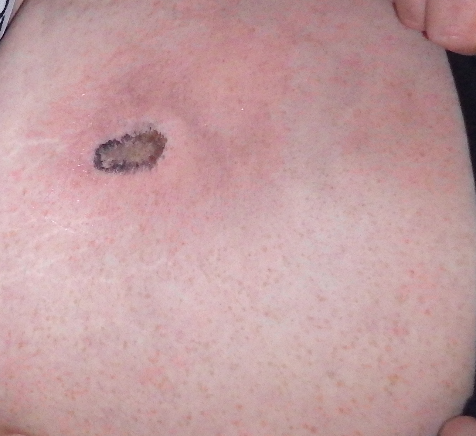 NB man receives painful burns after e cigarette battery explodes