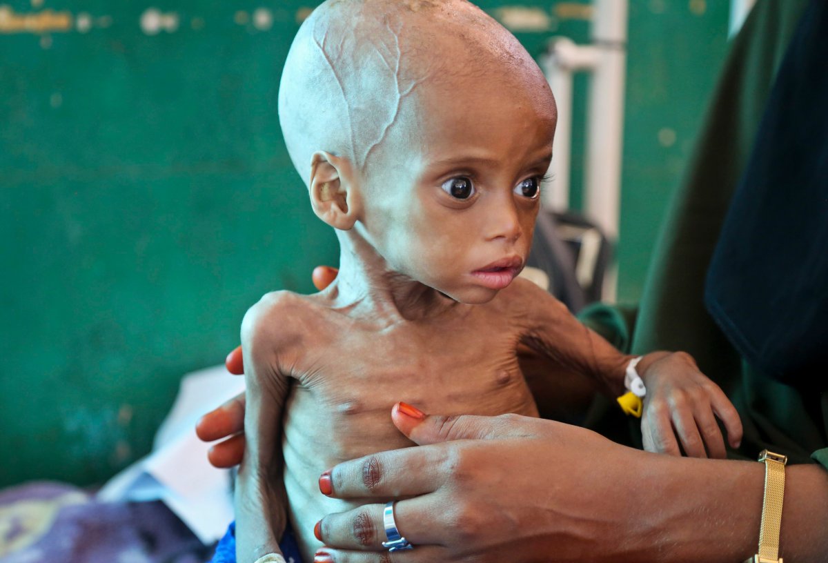 Acutely malnourished child Sacdiyo Mohamed, 9 months old, is treated at the Banadir Hospital after her mother Halima Hassan Mohamed fled the drought in southern Somalia and traveled by car to the capital Mogadishu, in Somalia Saturday, March 11, 2017.