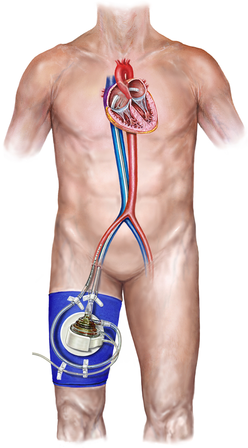 ‘TandemHeart’ helps make high-risk heart patients strong enough for surgery - image