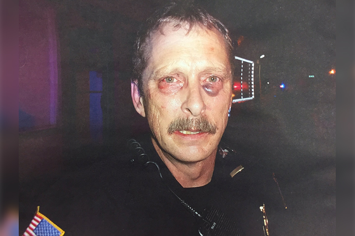 Lt. William Weldon is seen with deep bruising to his face and eyes after being attacked during a call on Sunday, April 2.