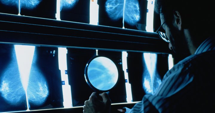 How this AI mammogram could help detect breast cancer years in advance 