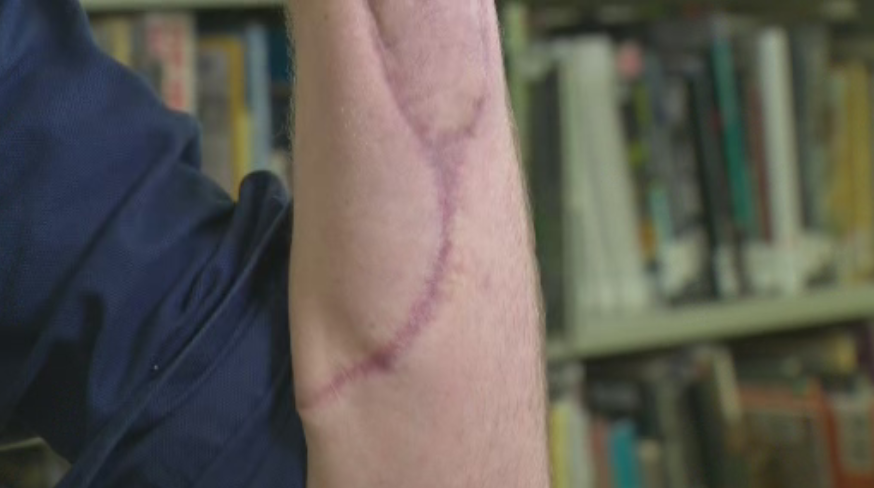 Multiple skin grafts were performed on Phillips’ arm, which was where the electricity exited his body. Exit wounds are typically larger than entry wounds.