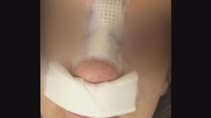 Tanya's son, a Grade 8 student at Woodhaven Middle School in Spruce Grove, needed surgery from a fight that left him with a broken nose and cheek bone and a severe injuries to his left eye.