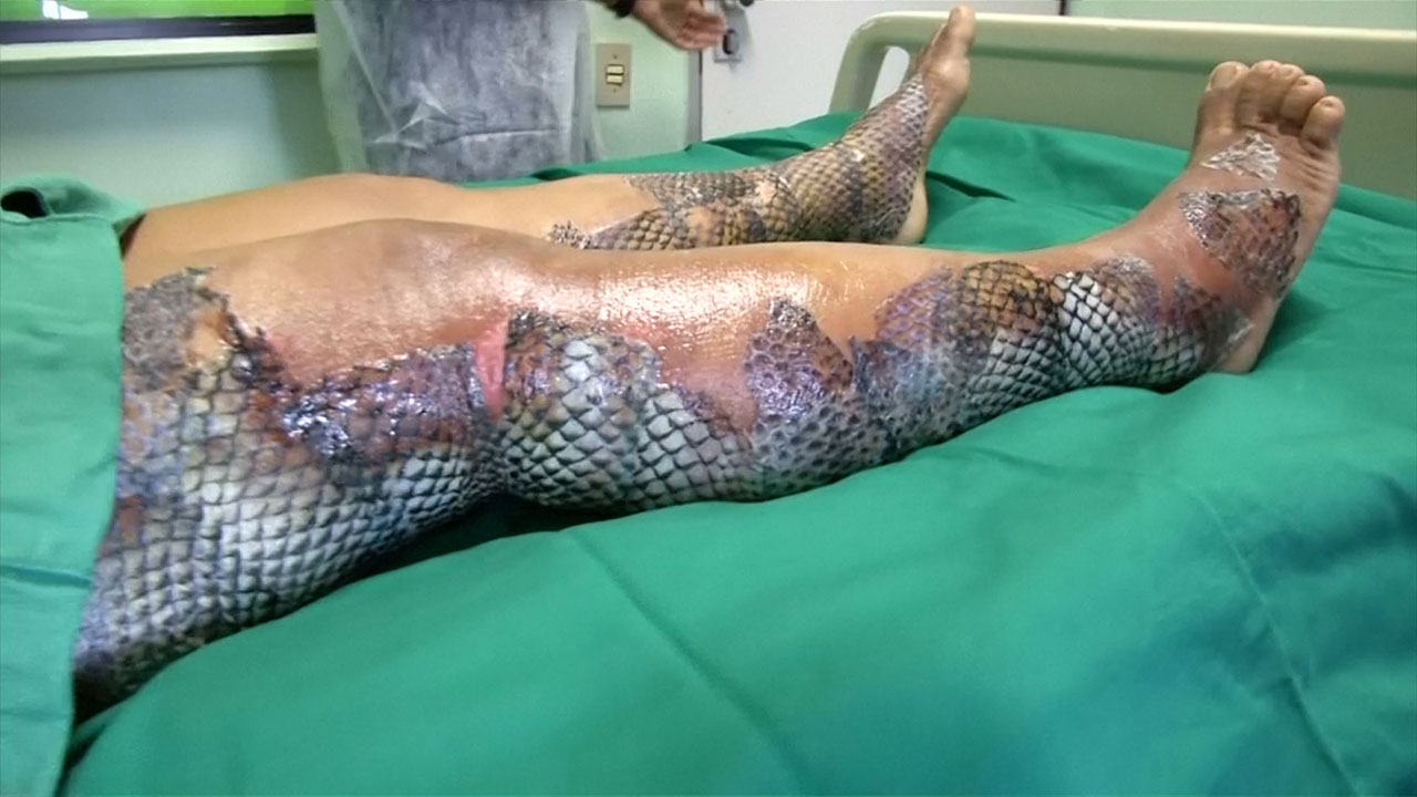 Brazilian doctors use fish skin to treat burn victims - National |  Globalnews.ca
