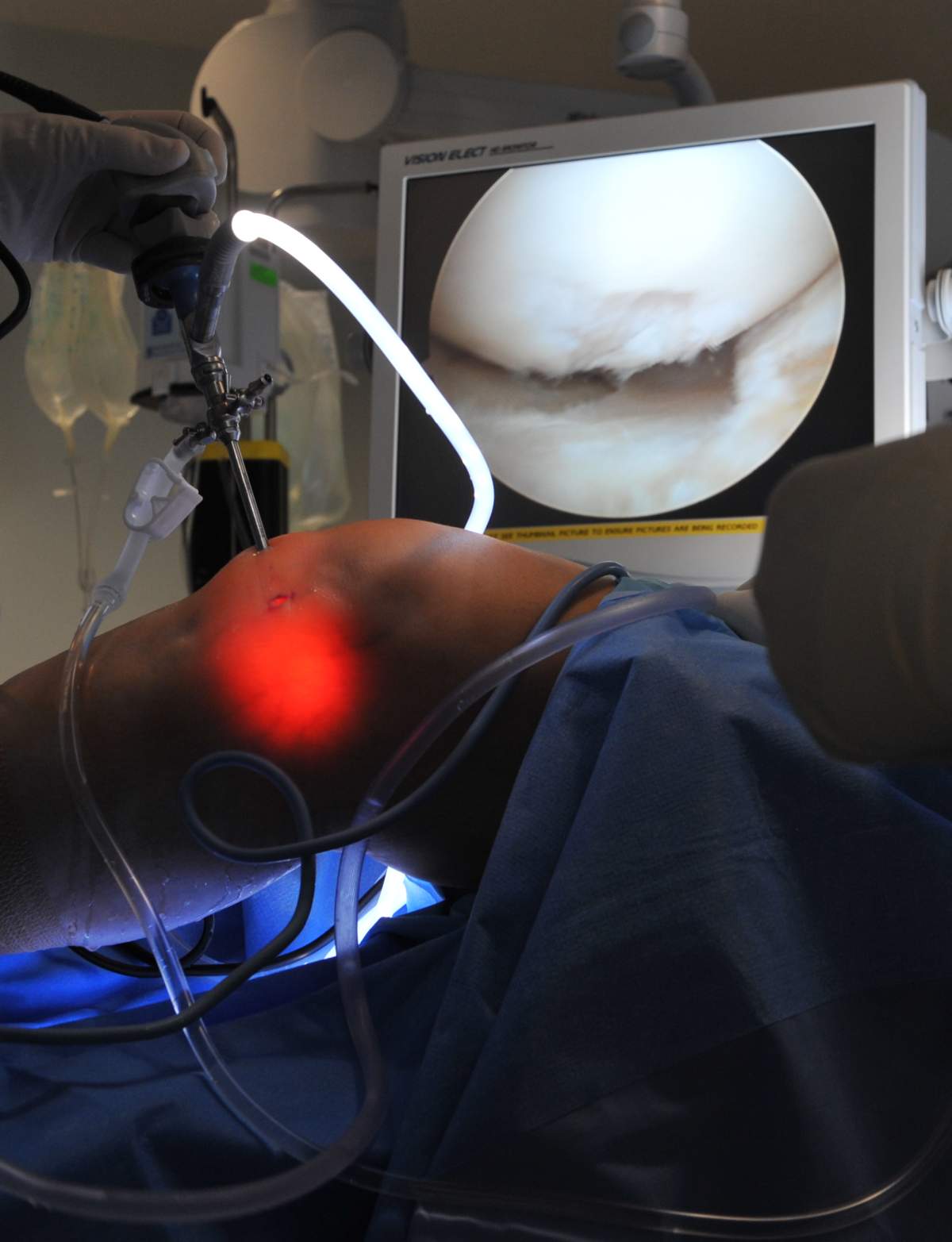 Dr. Ben Shaffer leads a team as they perform arthroscopic surgery on a knee at Sibley Memorial Hospital on March 3, 2010, in Washington, DC.  