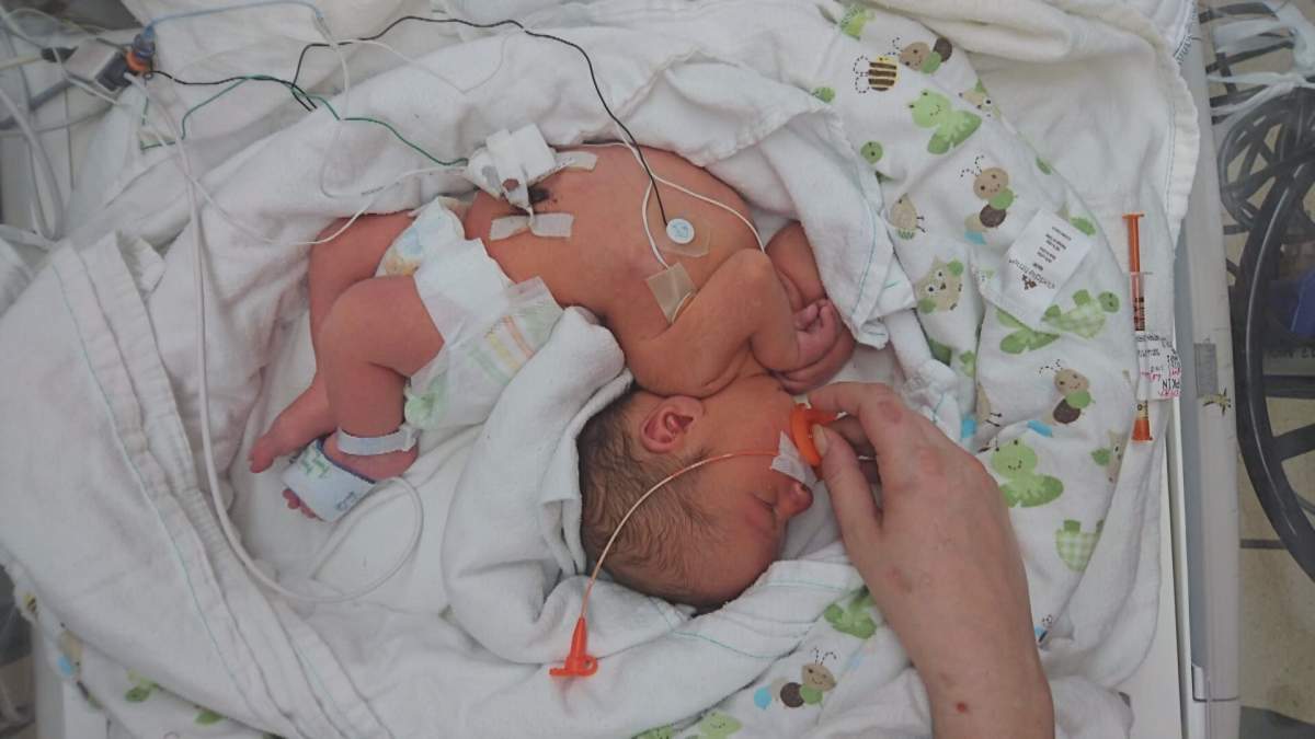 Rossy Hipkin was born with severe scoliosis and Arthrogryposis Multiplex Congenita (AMC).