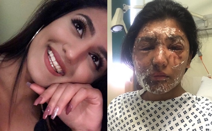 Resham Khan, 21, is suffering from severe burns to her face and body after a man threw acid at her and her cousin while stopped at traffic lights in London last week.