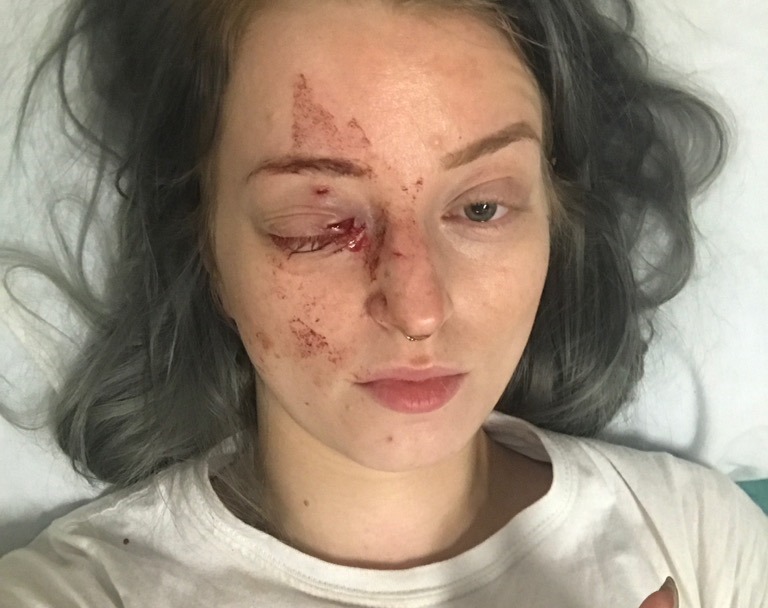 Brittney Thomas-Ljungberg was randomly attacked in the Exchange District Sunday afternoon.