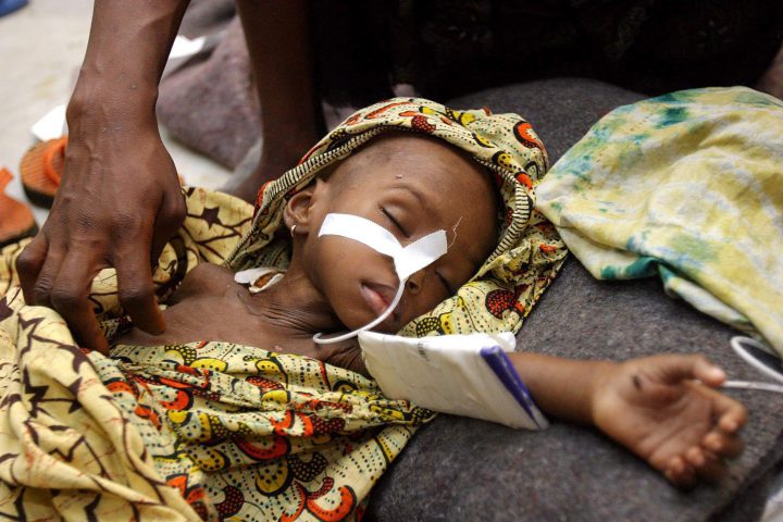 Liberian girl Edith Gboe, suffering from malaria and malnutrition lies asleep at the Medicines Sans Frontiers clinic, Monrovia on 28 July 2003. 