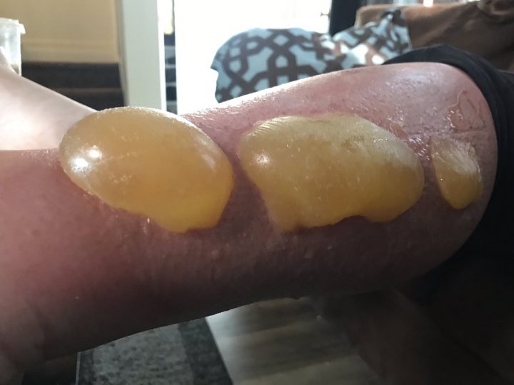 Saskatoon woman blames Banana Boat sunscreen for severe blisters - image