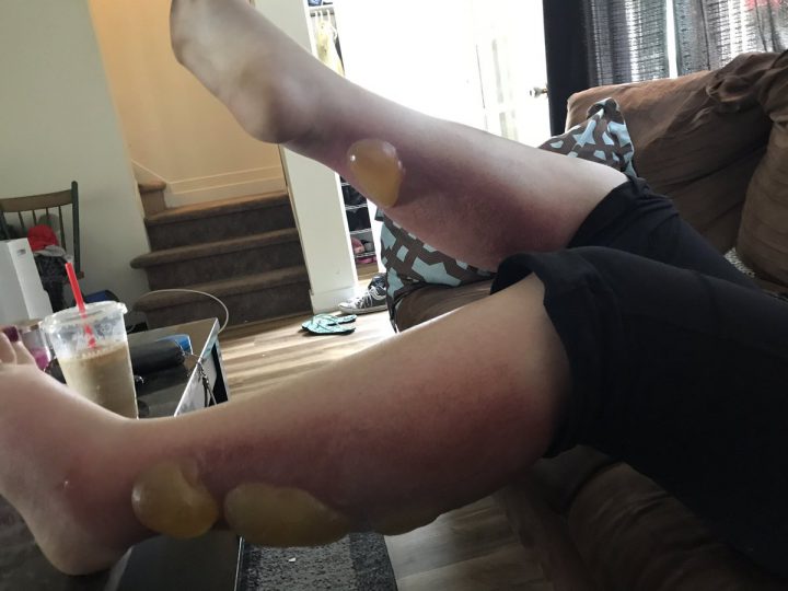 Saskatoon woman blames Banana Boat sunscreen for severe blisters - image