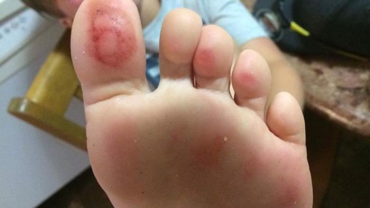 Prairie winds foot injuries