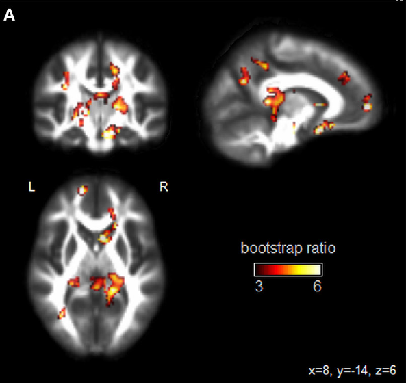 This scan shows parts of the brain that showed "reliable differences" between sports groups that played collision, contact and non-contact activities, in a study published in the journal Frontiers in Neurology.